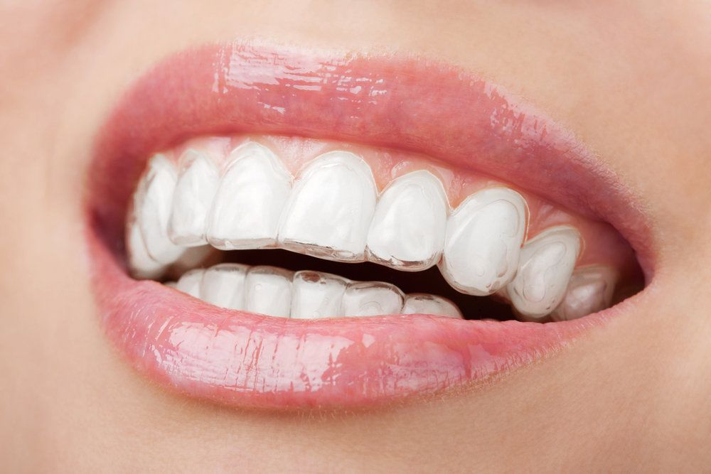 A close up of a person wearing Invisalign aligner trays.