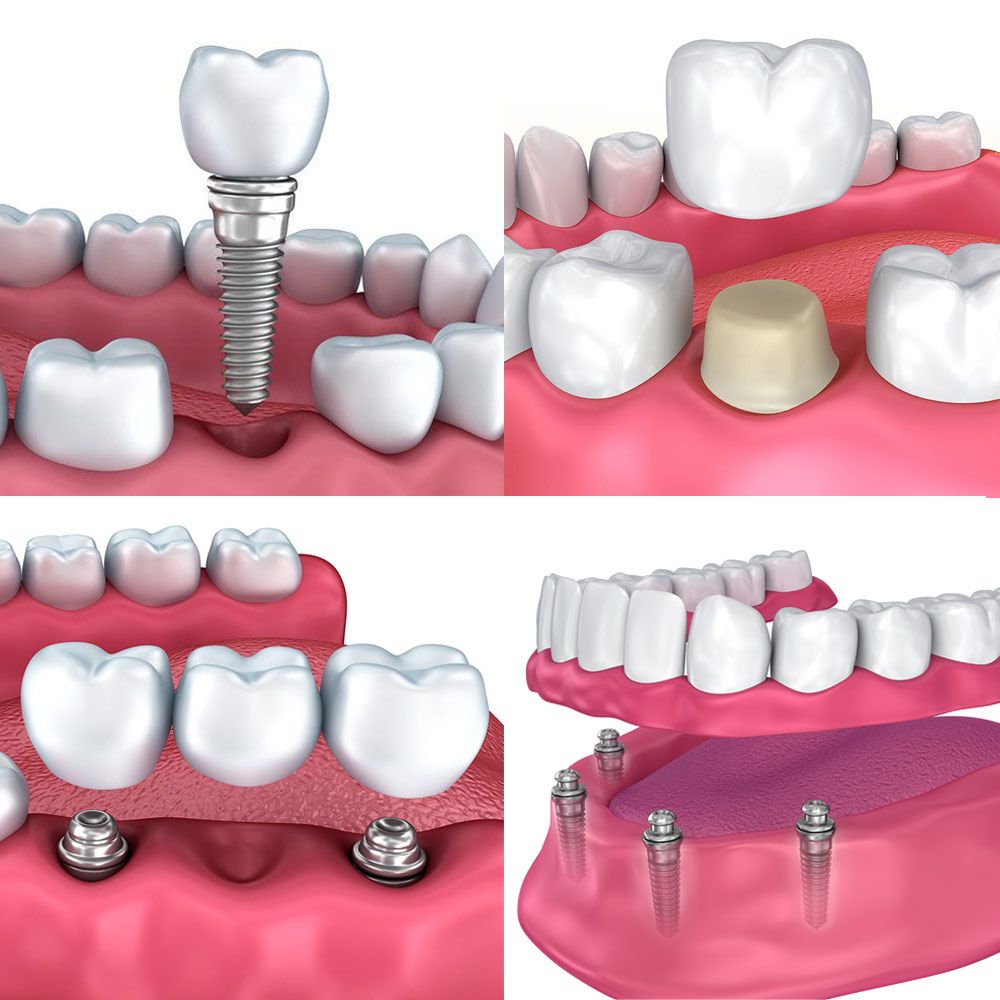 A single dental implant, a crown, a bridge, and full implant-supported dentures